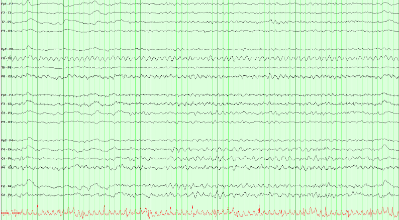 EEG recording with a regular rhythmic pattern during bedside care