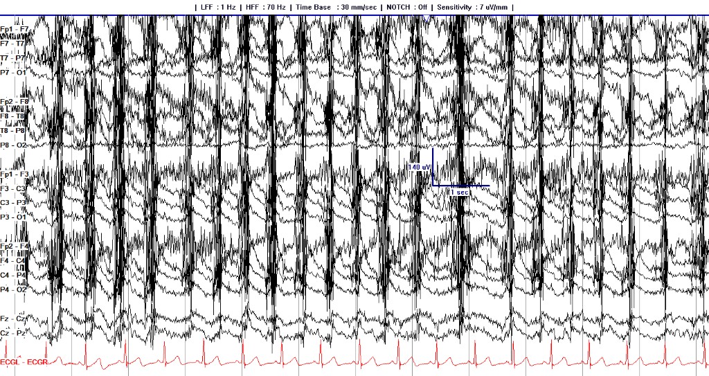 Longitudinal bipolar EEG with rhythmic high-amplitude muscle bursts from chewing