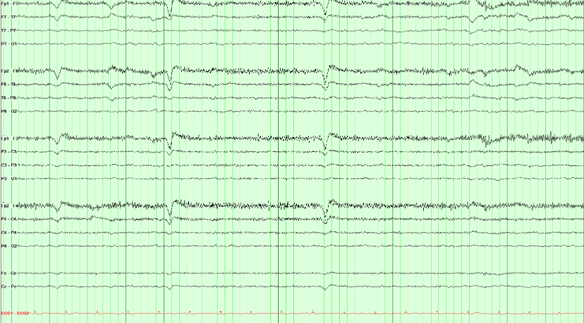 EEG recording with brief repeated anterior deflections