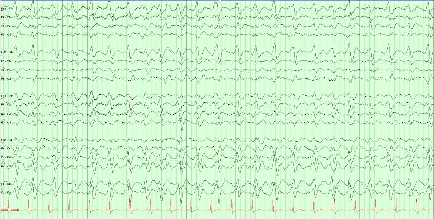Multichannel EEG recording with repetitive generalized complexes