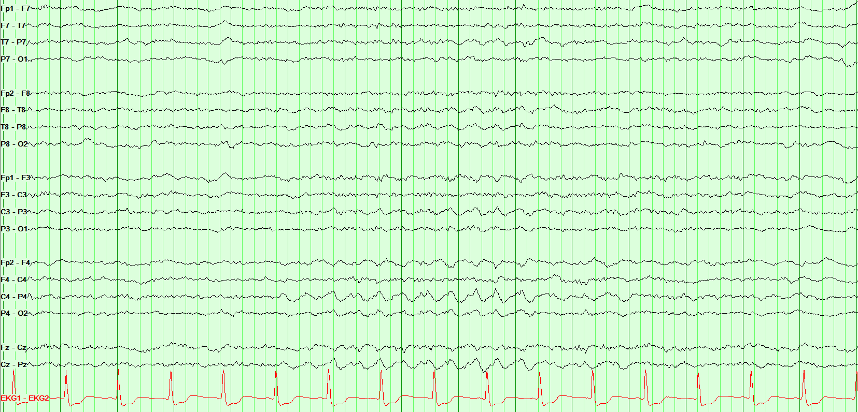 Multichannel EEG recording with lateralized rhythmic activity