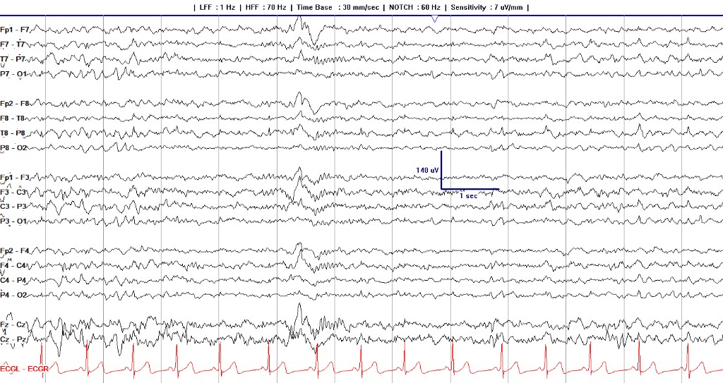 Sleep EEG recording with several central and frontocentral transients