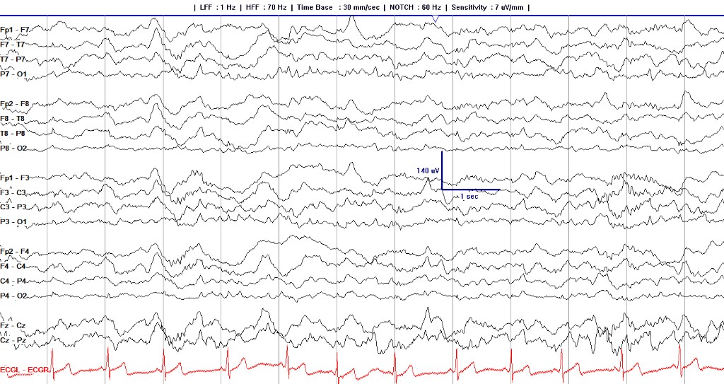 Sleep EEG dominated by high-voltage slow waves across all chains