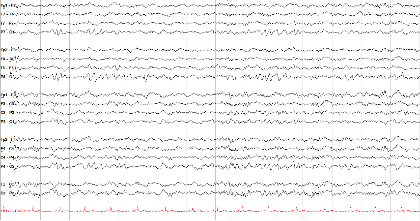 N1–N2 sleep EEG recording with repeated posterior transients