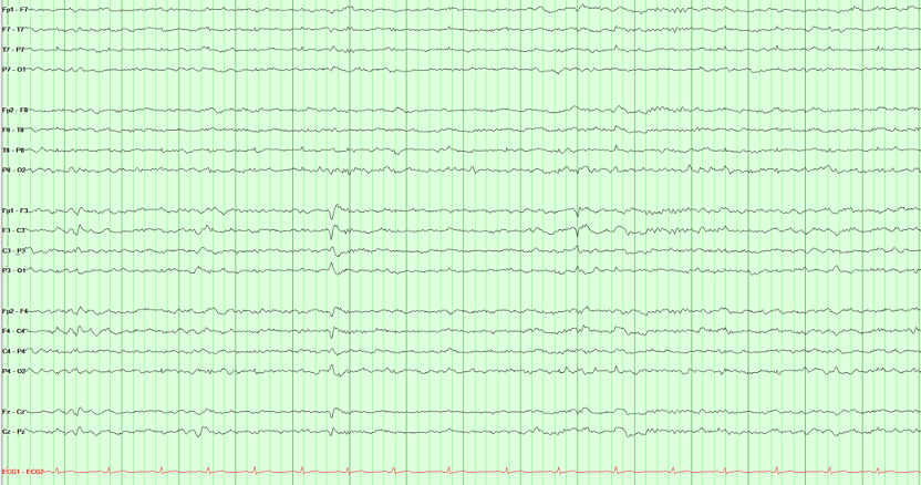 Sleep EEG recording with a single bilateral central transient
