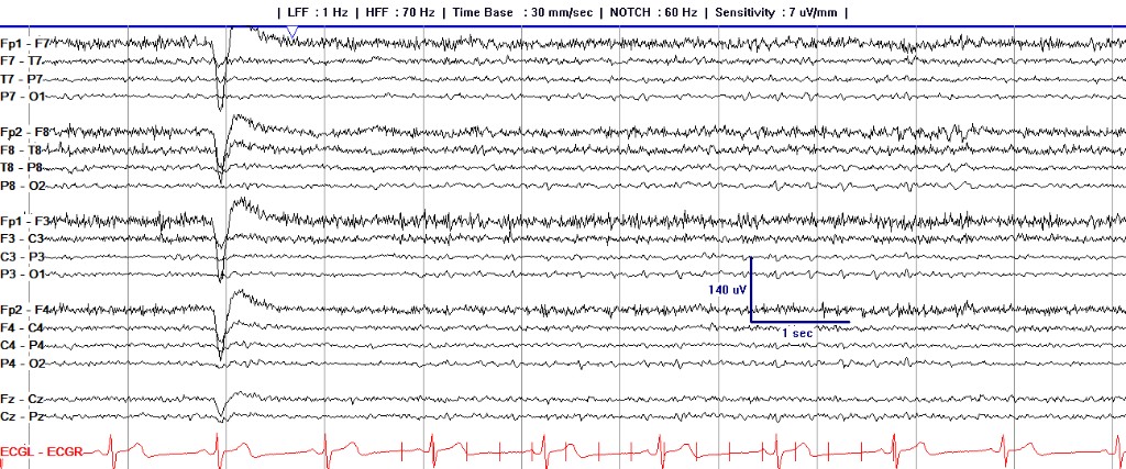 Awake longitudinal bipolar EEG page with left temporal, right temporal, parasagittal, and midline chains