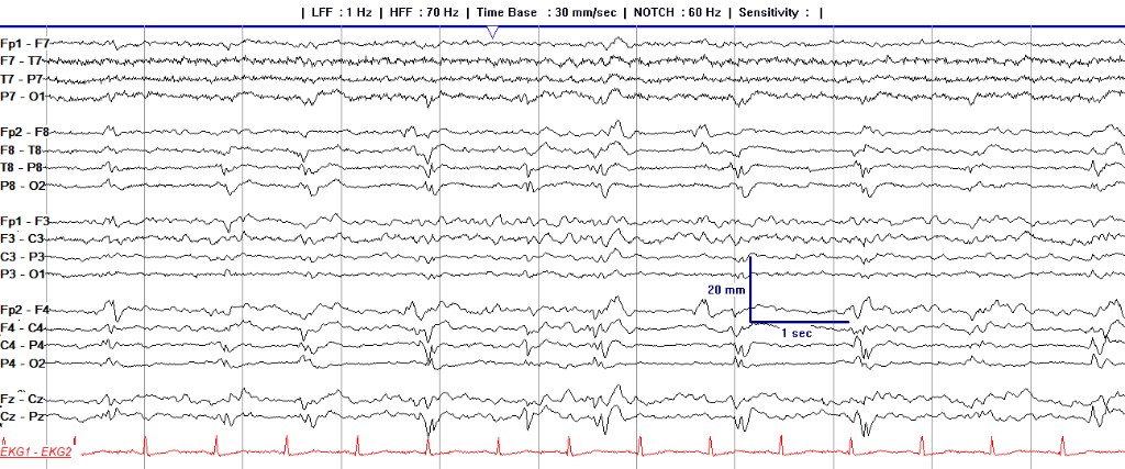 Longitudinal bipolar EEG with recurring right posterior periodic discharges