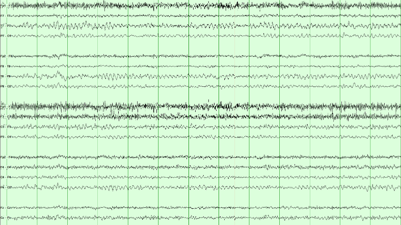 Awake adult eyes-closed EEG recording with frontal muscle activity