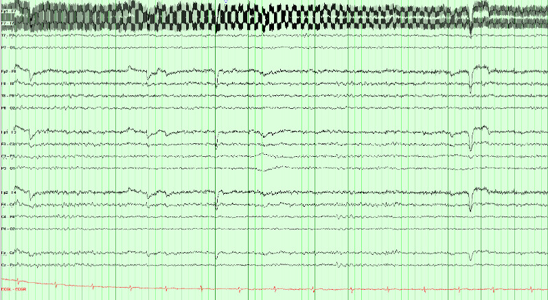Multichannel EEG recording with a localized fast technical disturbance