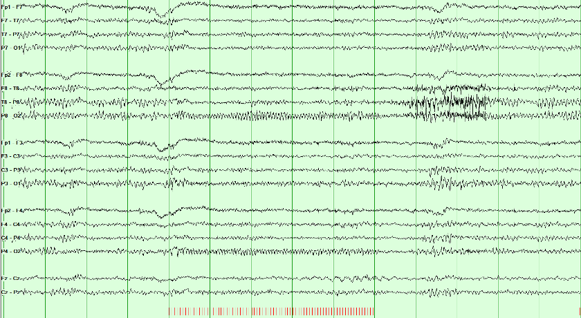 EEG recording during a marked train of intermittent photic stimulation