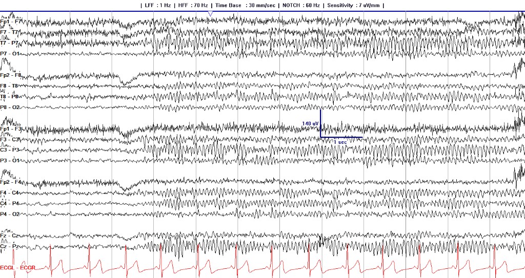 Awake longitudinal bipolar page with a well-formed posterior dominant rhythm maximal at O1 and O2