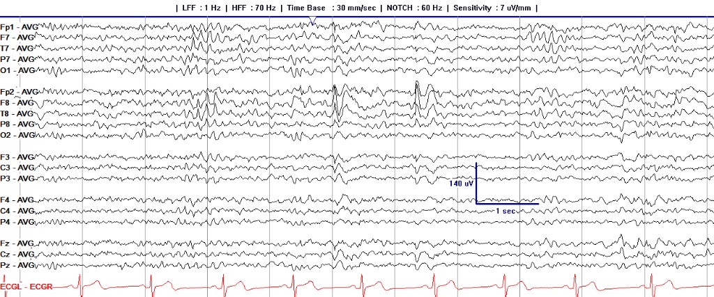 Right temporal sharp wave displayed as electrode minus common average, maximal at F8 and T8