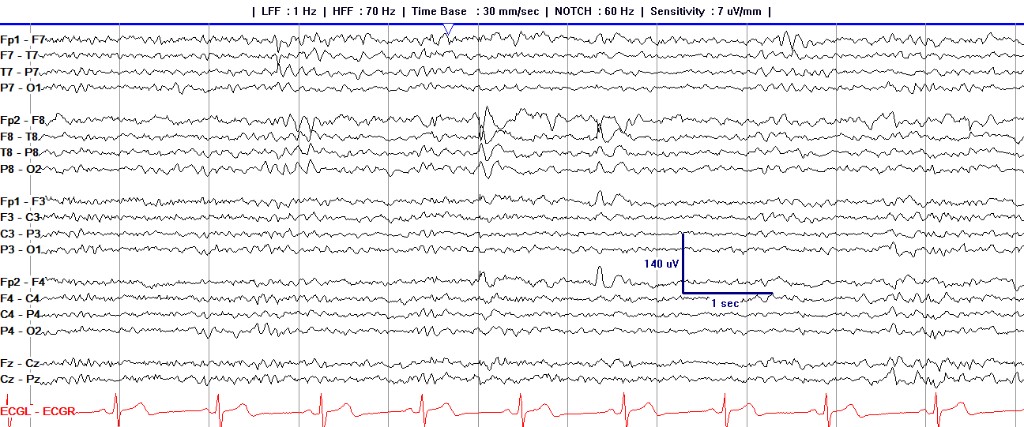 Sixteen-channel longitudinal bipolar EEG recording presented for localization practice