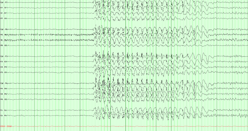 EEG recording presented for onset-localization practice