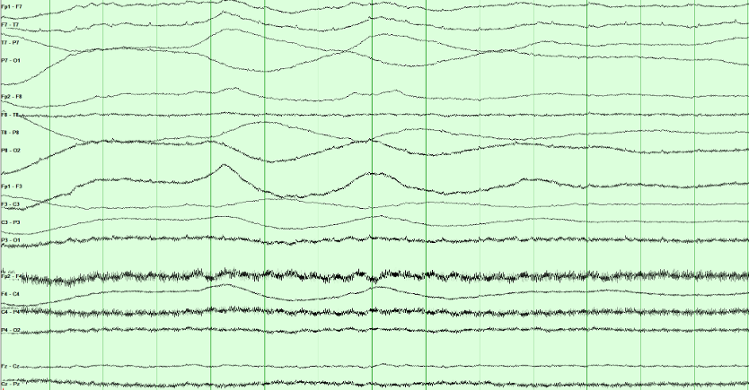Multichannel EEG recording with slow baseline shifts that are greatest anteriorly