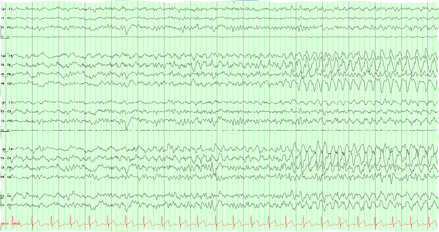 Longitudinal bipolar EEG with an evolving focal seizure presented for chain localization practice