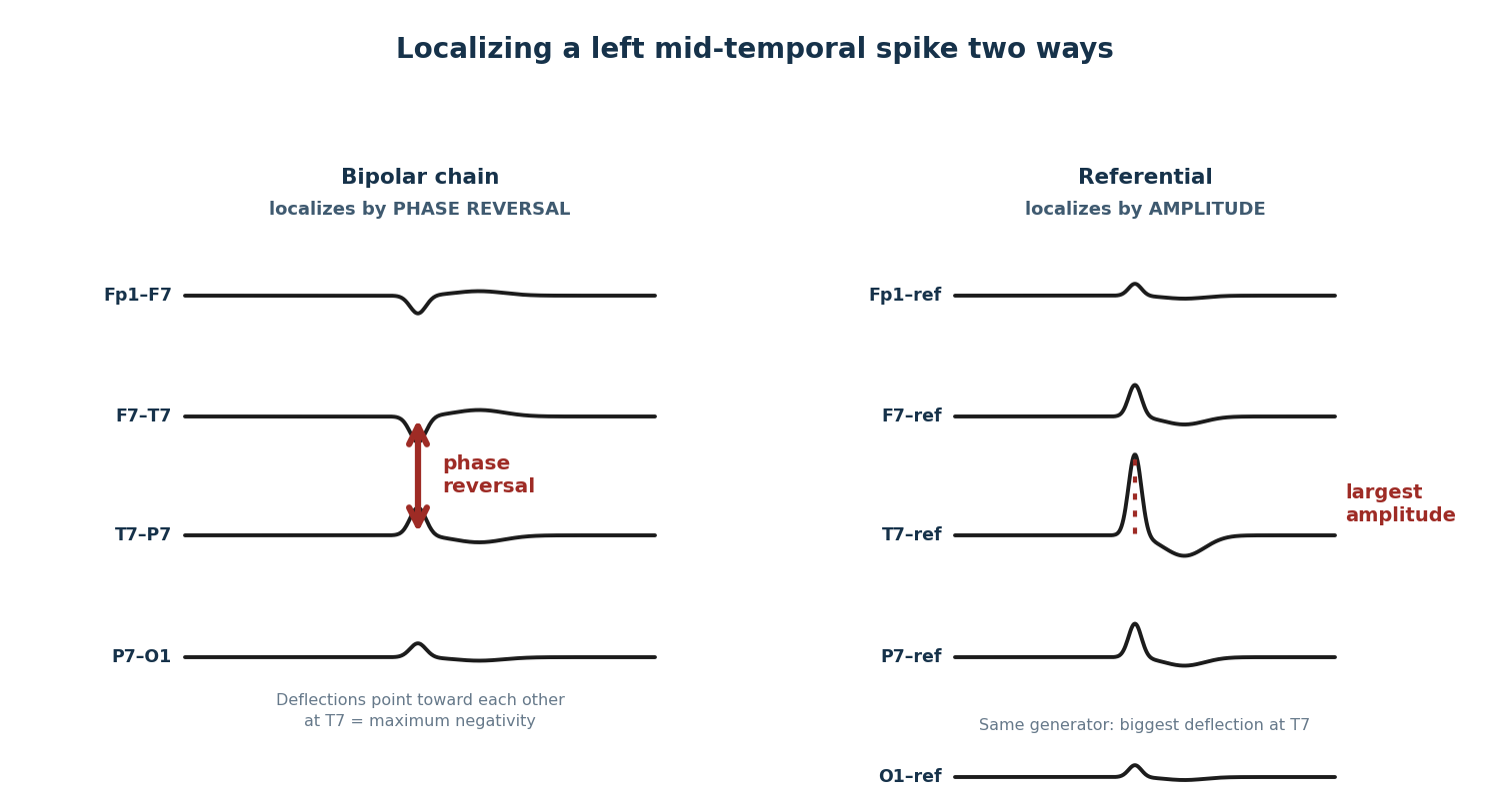 Side-by-side schematic of one left mid-temporal discharge shown in bipolar channels and referential channels