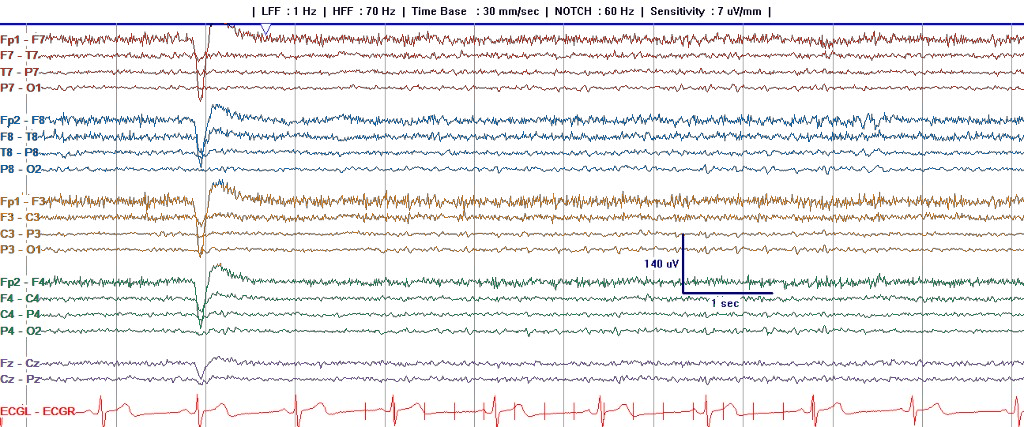 Clinical longitudinal bipolar EEG page with left temporal, right temporal, left parasagittal, right parasagittal, and midline chains colored to match the map below